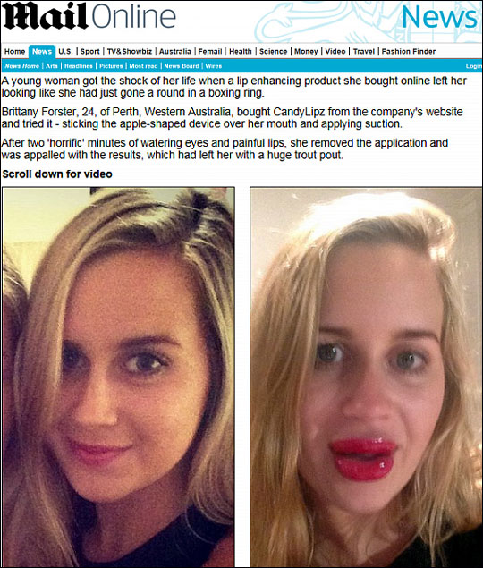 호주의 20대 여성이 셀프 입술성형기기로 입술을 부풀리다 부작용에 얼굴이 망가져 화제다. 영국 데일리메일 화면 캡처