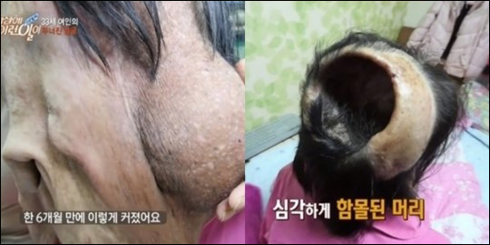 '세상에이런일이' 신경섬유종 환자 돕기 열기가 뜨겁다. SBS 방송 캡처.