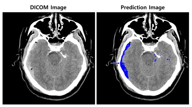 뇌출혈이 의심되는 환자의 뇌 CT 영상을 뇌출혈 영상 판독 AI모델이 출혈 병변 존재와 위치를 식별한 영상ⓒSK㈜ C&C