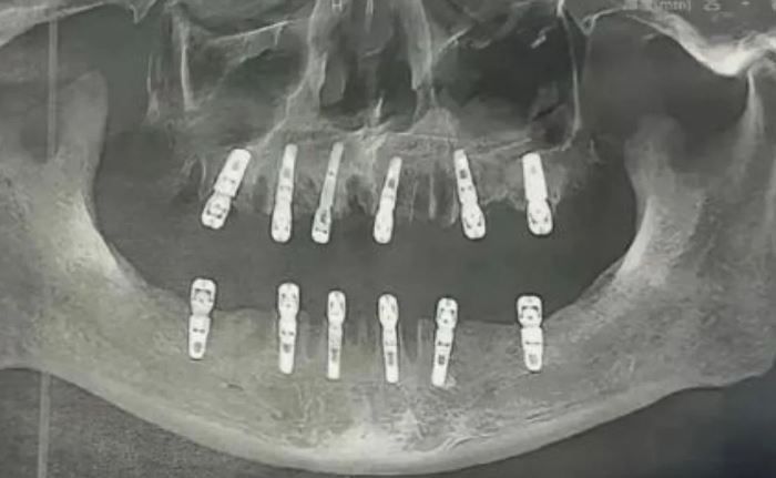 하루에 치아 23개 뽑고 임플란트 12개 한 중국인…13일 후 사망