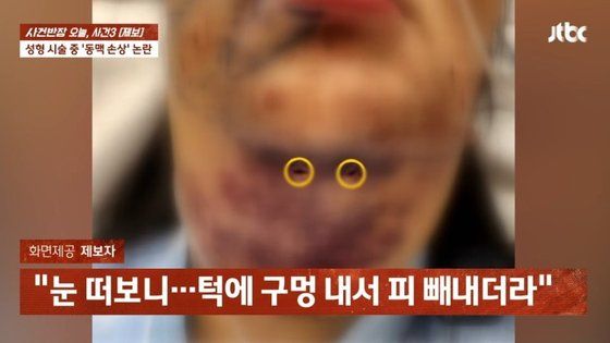 지방흡입 시술 받고 턱 뚫린女…의사 "안 죽어" 나몰라라 대응