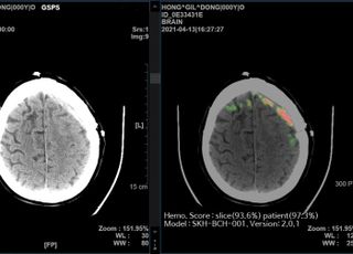 SK㈜ C&amp;C가 개발한 AI 뇌출혈 영상 솔루션, '아소시오 헬스테크 어워드' 수상