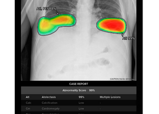루닛, 삼성전자 엑스레이 장비에 흉부·응급질환 AI 솔루션 공급