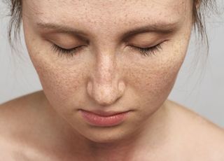 자외선 강해지는 시기 닮은듯 다른 피부질환 3가지