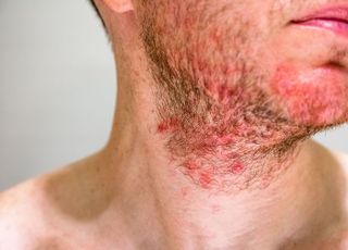 [데일리 헬스] 여름철 주의해야 할 피부질환 '지루성피부염'...여드름 증상과 유사