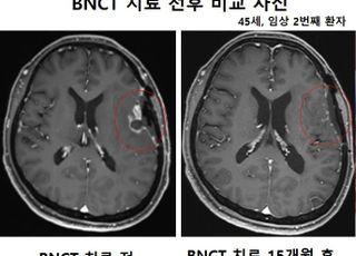 가천대 길병원, 붕소중성자포획치료기(A-BNCT) 개발…“국내 최초”