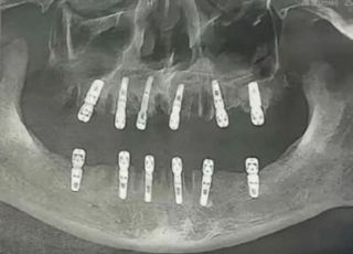 하루에 치아 23개 뽑고 임플란트 12개 한 중국인…13일 후 사망