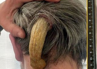 머리에 13cm 뿔이? “통증 때문에 일상생활 불가”