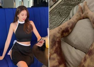 아옳이 이겼다...法 “‘건강주사 맞고 전신피멍’ 주장, 허위사실 아냐”