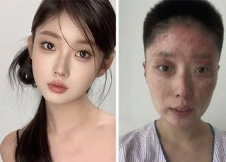 아버지 담뱃불에 '펑'...전신 화상 공개한 뷰티 인플루언서