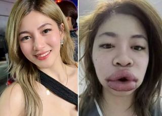 입술 무슨 일?...필러 알레르기 무시했다가 혼쭐난 女