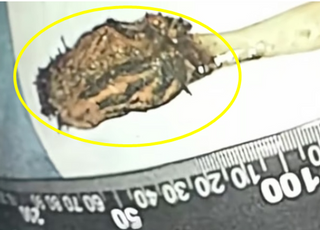 60대男 뱃속에서 발견된 ‘이거’...무려 길이만 17cm
