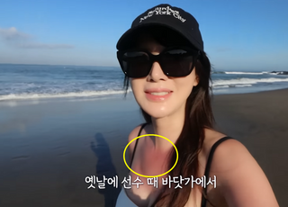 [데일리 헬스] ‘안정환 아내’ 이혜원 “햇살에 탔다”...열광화상 입었다면?