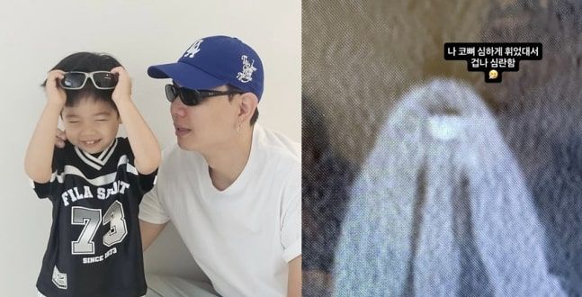 홍현희 남편 제이쓴, 코뼈 심하게 휘어져...원인과 예방법은 [데일리 헬스]