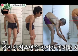 이동건 '강직성 척추염'이었다 "평생 관리, 방치하면..."