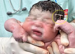 갓 태어난 아기 손에 들린 '이것'은? "1% 가능성 뚫은 아이"