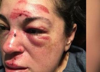 보도블록 걸려 넘어졌는데 보상금 '106억'...상태보니 심각