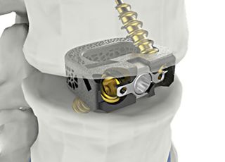 시지메드텍, 척추 임플란트 '유니스페이스' FDA 승인