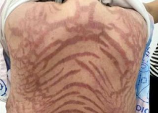 전신에 끔찍한 무늬 생긴 女, 10년간 바른 것 때문이었다