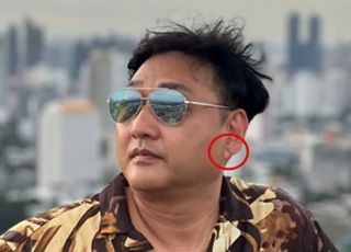 김수용 귓불에 전조 증상 있었다?...'프랭크징후' 뭐길래