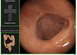 서울대병원, AI 기반 가상 대장내시경 시뮬레이터 개발