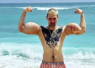 '러시아 뽀빠이' 양팔 잃을 위기...OO 주사 때문?