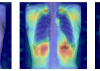 "흉부 X선으로 골다공증 상태 예측"…서울대병원, AI 모델 개발
