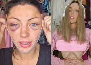 '인간 바비' 되려고 30번 수술한 인플루언서 사망...무슨 일?