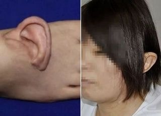 귀 뜯긴 30대女, '특별한 방법'으로 귀 되찾았다