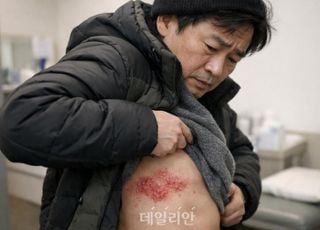찌르는 듯한 고통 '대상포진'…왜 겨울에 빈번할까 [엑스레이]